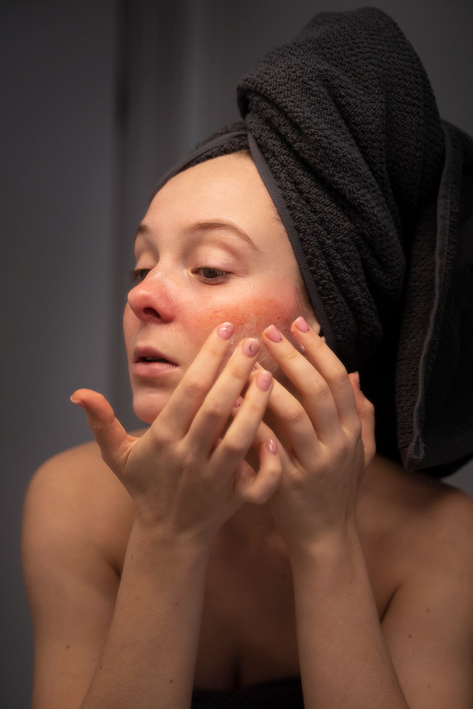 Acne Treatment